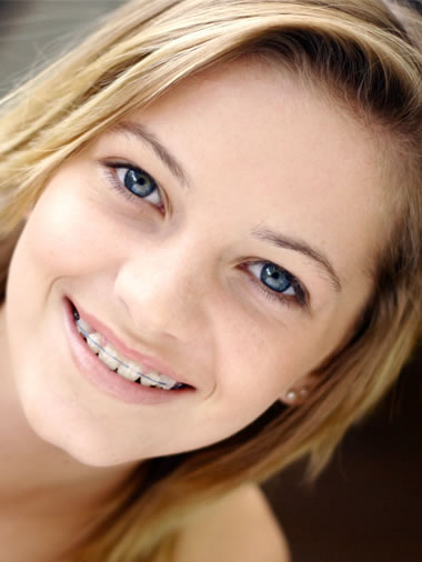 clear braces